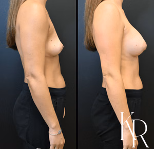 Breast augmentation before and after photo, side view