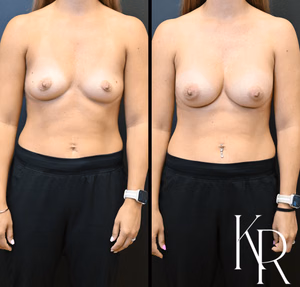 Breast augmentation before and after photo, front view