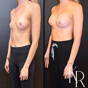 Breast augmentation before and after photo, front view
