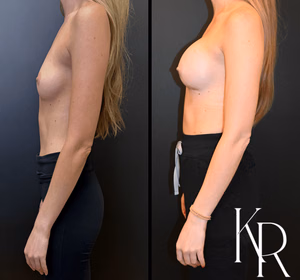 Breast augmentation before and after photo, side view