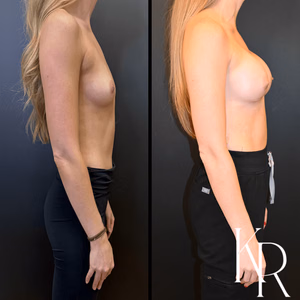 Breast augmentation before and after photo, side view