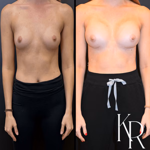 Breast augmentation before and after photo, front view