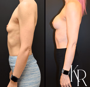 Breast augmentation before and after photo, side view