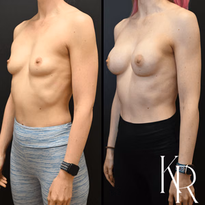 Breast augmentation before and after photo, front view