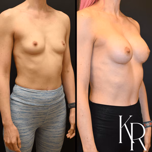 Breast augmentation before and after photo, front view