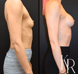 Breast augmentation before and after photo, side view