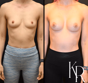 Breast augmentation before and after photo, front view