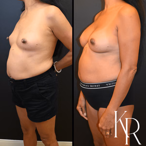 Breast augmentation before and after photo, front view