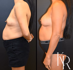 Breast augmentation before and after photo, side view