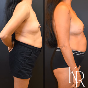 Breast augmentation before and after photo, side view