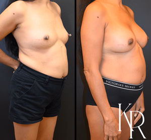 Breast augmentation before and after photo, front view