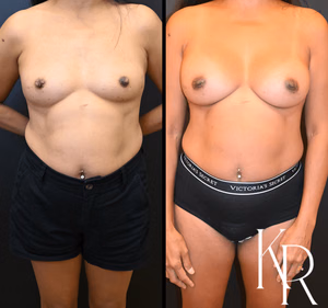 Breast augmentation before and after photo, front view