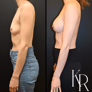 Breast augmentation before and after photo, side view