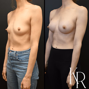 Breast augmentation before and after photo, front view
