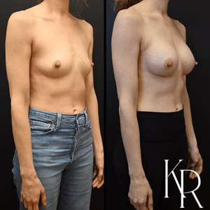 Breast augmentation before and after photo, front view