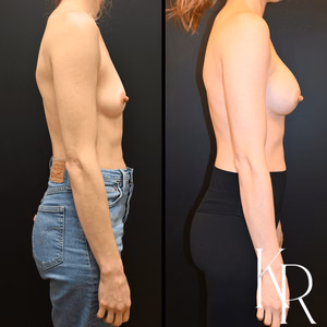 Breast augmentation before and after photo, side view