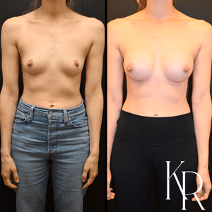 Breast augmentation before and after photo, front view