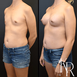 Breast augmentation before and after photo, front view