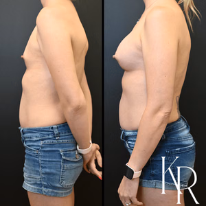 Breast augmentation before and after photo, side view