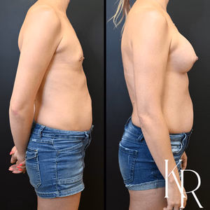 Breast augmentation before and after photo, side view