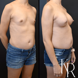 Breast augmentation before and after photo, front view