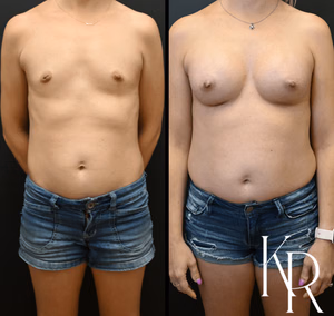 Breast augmentation before and after photo, front view
