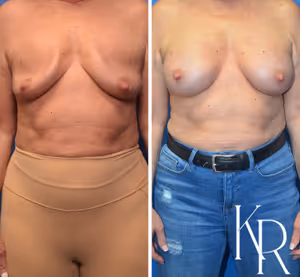 Breast augmentation revision before and after photo, front view