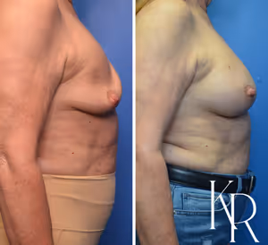 Breast augmentation revision before and after photo, side view