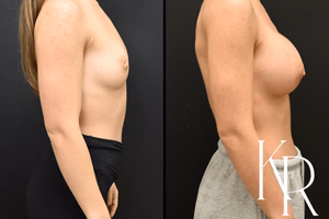 Breast augmentation before and after photo, side view