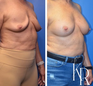 Breast augmentation revision before and after photo, front view