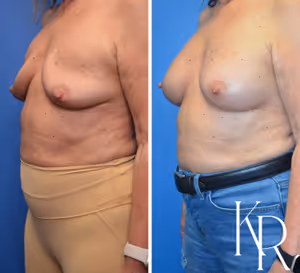Breast augmentation revision before and after photo, front view