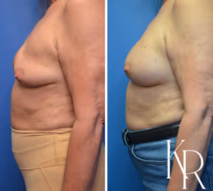 Breast augmentation revision before and after photo, side view