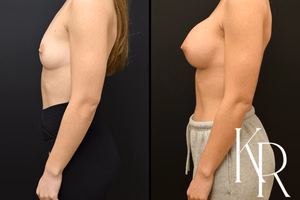 Breast augmentation before and after photo, side view