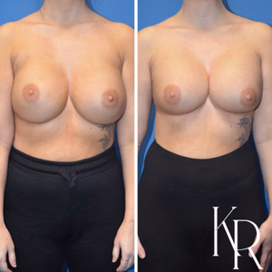 Breast augmentation revision before and after photo, front view