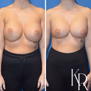 Breast augmentation revision before and after photo, front view