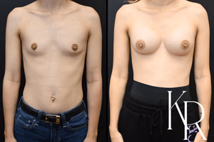 Breast augmentation before and after photo, front view