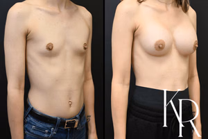 Breast augmentation before and after photo, side view