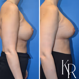 Breast augmentation revision before and after photo, side view