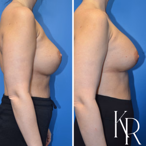 Breast augmentation revision before and after photo, side view
