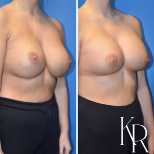 Breast augmentation revision before and after photo, front view