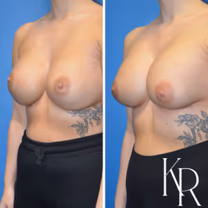 Breast augmentation revision before and after photo, front view