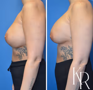 Breast augmentation revision before and after photo, side view