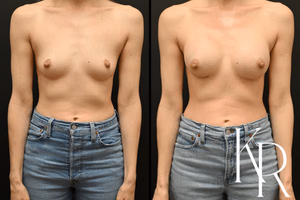 Breast augmentation before and after photo, front view