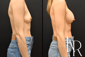 Breast augmentation before and after photo, side view