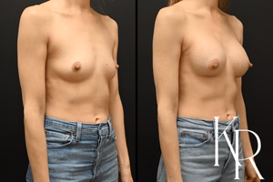Breast augmentation before and after photo, front view