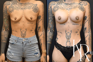 Breast augmentation before and after photo, front view