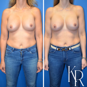 Breast augmentation revision before and after photo, front view
