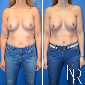 Breast augmentation revision before and after photo, front view
