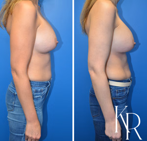Breast augmentation revision before and after photo, side view