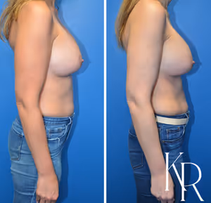Breast augmentation revision before and after photo, side view